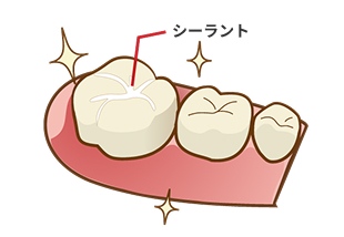 シーラントの画像